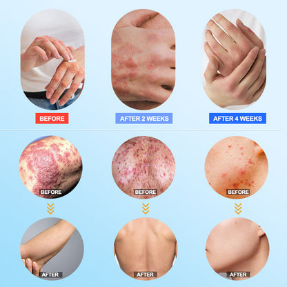 👍Official Store:DermaCalm Magnesium Herbal Intimate -Fast Relief for Psoriasis & Eczema|No-Rub, Steroid-Free,[Unisex]-Tax Free