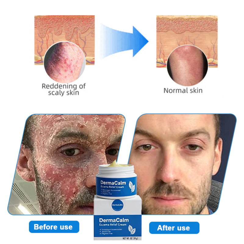 👍Official Store:DermaCalm Magnesium Herbal Intimate -Fast Relief for Psoriasis & Eczema|No-Rub, Steroid-Free,[Unisex]-Tax Free