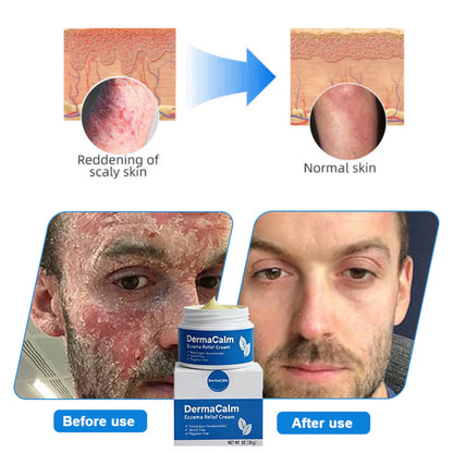 👍Official Store:DermaCalm Magnesium Herbal Intimate -Fast Relief for Psoriasis & Eczema|No-Rub, Steroid-Free,[Unisex]-Tax Free